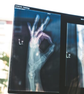 X-ray of a hand signalling OK, with thumb and index touching